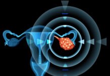 Ovarian Cancer: Stages and Treatment