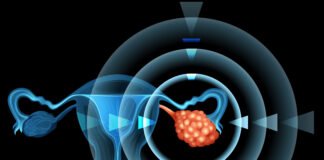 Ovarian Cancer: Stages and Treatment