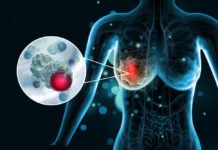 Breast Cancer: Stages and Treatment