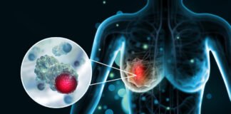 Breast Cancer: Stages and Treatment